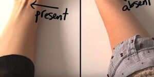 If a Tendon Raises Up When You Touch Your Pinky to Your Thumb, Here’s What It Could Mean