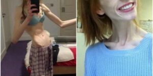 She weighed 60 pounds – After a 5-year-long battle with anorexia this is what she looks like today