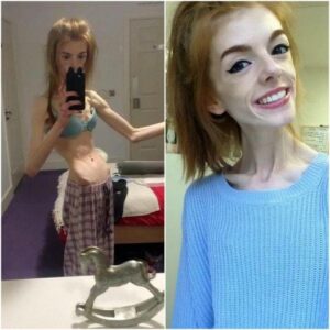 She weighed 60 pounds – After a 5-year-long battle with anorexia this is what she looks like today